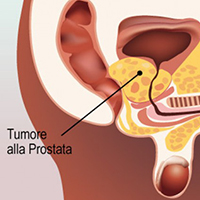 tumore prostata