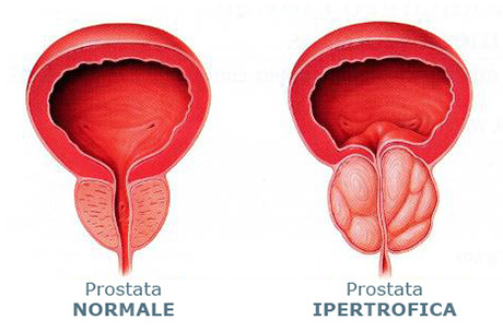 Adenomul de prostata – evolutie, diagnostic, tratament | fanfarapr.ro