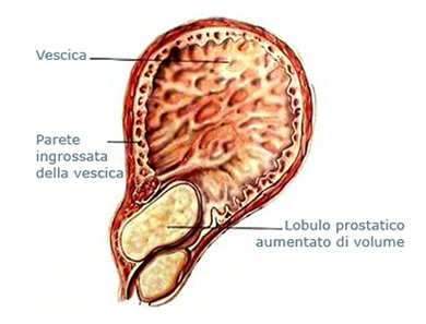 Prostata aumentata di volume, Termotherapy for prostatitis